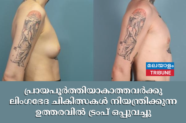 പ്രായപൂർത്തിയാകാത്തവർക്കു ലിംഗഭേദ ചികിത്സകൾ നിയന്ത്രിക്കുന്ന ഉത്തരവിൽ ട്രംപ് ഒപ്പുവച്ചു