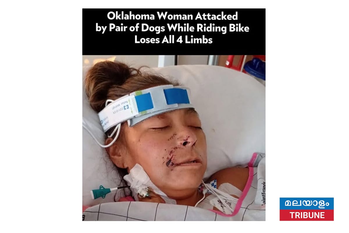 രണ്ട് പിറ്റ് ബുളുകളുടെ ആക്രമണത്തിൽ സ്ത്രീയുടെ കൈകാലുകൾ നഷ്ടപ്പെട്ടു